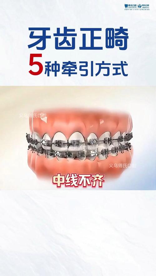 牙科正畸牵引圈的具体用法是什么?不同牙齿错颌畸形如何选择牵引方式?操作步骤和常见误区有哪些?-图2 牙科正畸牵引圈的具体用法是什么?不同牙齿错颌畸形如何选择牵引方式?操作步骤和常见误区有哪些?-图2