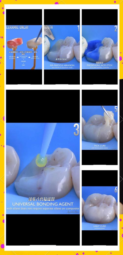 嵌体泥使用时材料调拌比例和操作步骤有哪些注意事项?如何确保嵌体与窝洞边缘密合且避免气泡产生?-图1 嵌体泥使用时材料调拌比例和操作步骤有哪些注意事项?如何确保嵌体与窝洞边缘密合且避免气泡产生?-图1