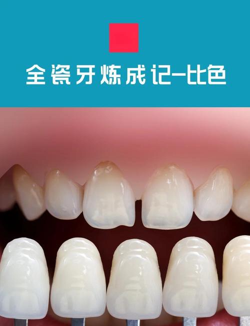 备牙前比色如何确保修复体颜色自然逼真?比色板选择与自然光环境下的关键操作要点是什么?-图2 备牙前比色如何确保修复体颜色自然逼真?比色板选择与自然光环境下的关键操作要点是什么?-图2