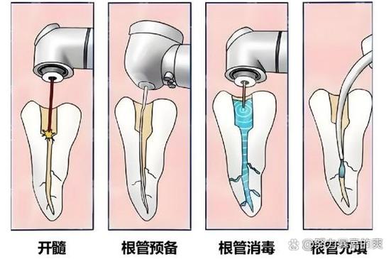 后牙拔髓的具体操作步骤有哪些?不同根管形态下使用方法有何注意事项?-图1 后牙拔髓的具体操作步骤有哪些?不同根管形态下使用方法有何注意事项?-图1