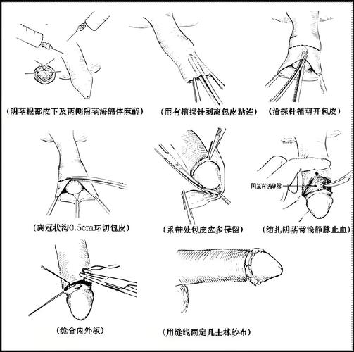 分根术的手术方法具体如何操作？不同适应症下的关键步骤、技术细节及术后注意事项有哪些？-图2
