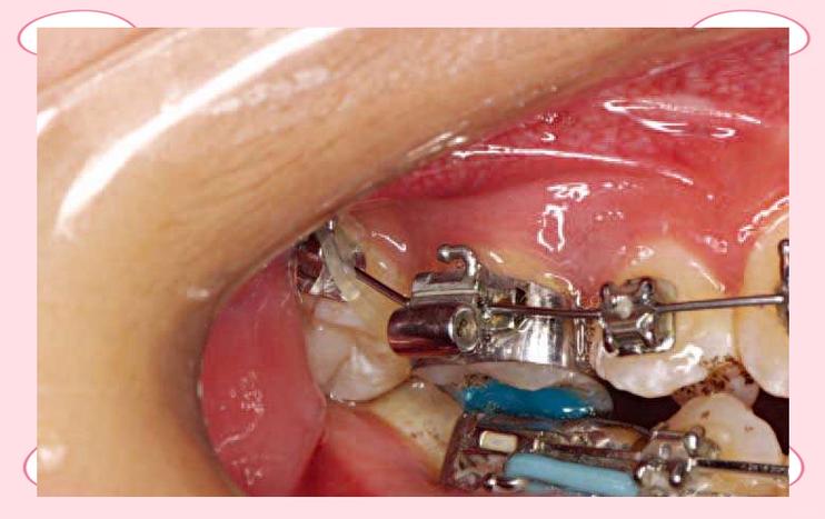 正畸上带环的详细步骤-图2