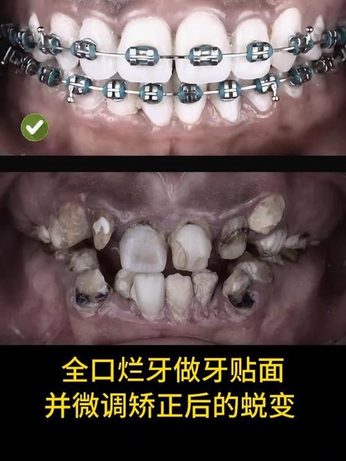蛀牙严重到什么程度就不能做正畸？必须先治好蛀牙才能戴牙套矫正吗？-图1