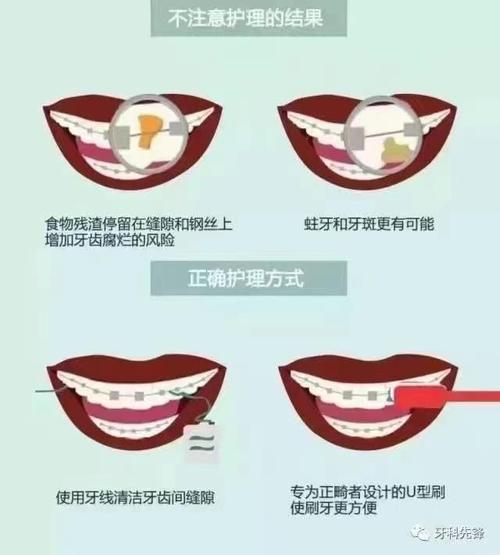 正畸期间牙齿护理有哪些常见误区？掌握哪些正确清洁方法才能避免牙套脸和蛀牙？-图1