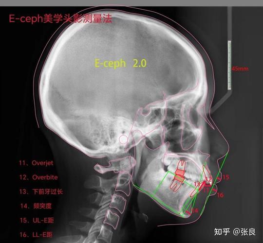 正畸头影测量视频讲座中，临床医生如何精准掌握标志点定位与数据分析的核心技巧？-图2