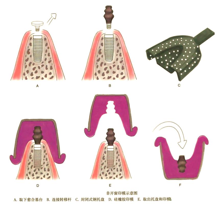 种植体取出有哪些具体方法？不同骨结合状态和种植年限下如何选择术式？-图2