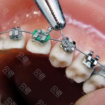 口腔正畸悬吊结扎法图解,操作步骤有哪些?与传统结扎法相比优势在哪?适用哪些错颌畸形病例?-图1 口腔正畸悬吊结扎法图解,操作步骤有哪些?与传统结扎法相比优势在哪?适用哪些错颌畸形病例?-图1