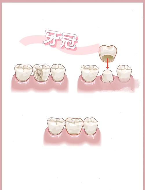 牙齿茜体支配方法具体指什么？其实施步骤和适用场景有哪些？-图2