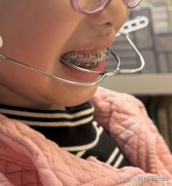 为什么牙齿正畸牵引牙时会特别痛？这种剧烈疼痛是正常的生理反应吗？该如何有效缓解牵引牙带来的不适？-图1