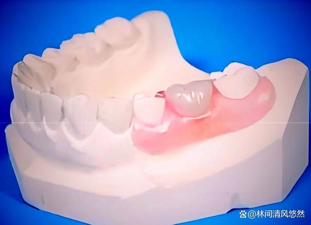 义齿隐形制作方法中，数字化扫描、3D打印及材料选择如何协同保障精准适配与隐形效果？-图2