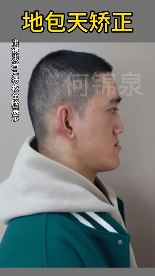 正畸正颌联合治疗术后，患者最关心的恢复时间、效果维持及日常护理要点有哪些？-图3