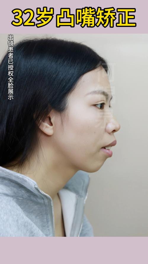 正畸正颌联合治疗术后，患者最关心的恢复时间、效果维持及日常护理要点有哪些？-图2