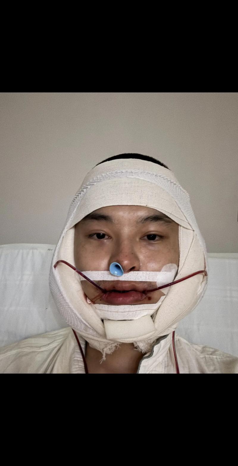 正畸正颌联合治疗术后，患者最关心的恢复时间、效果维持及日常护理要点有哪些？-图1