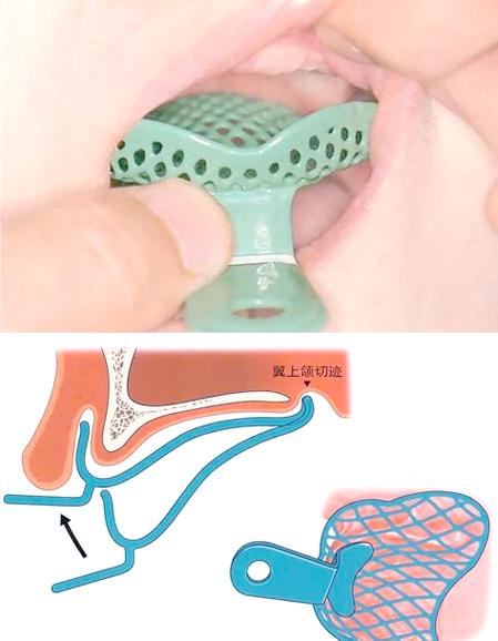 全口牙取模有哪些常用方法?不同方法在操作步骤和适用人群上有何区别?如何确保取模过程的准确性与舒适度?-图1 全口牙取模有哪些常用方法?不同方法在操作步骤和适用人群上有何区别?如何确保取模过程的准确性与舒适度?-图1