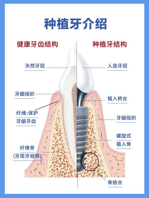 种植牙的具体方法有哪些？不同种植技术（如即刻种植、微创种植等）适用于哪些牙齿缺失情况，患者该如何根据自身条件选择？-图2