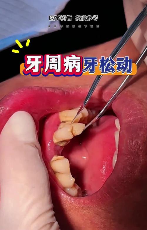牙周严重到何种程度会让牙医拒绝正畸？背后隐藏着哪些不可忽视的健康风险？-图1