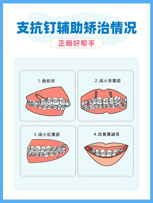 正畸治疗中，患者可以自行携带支抗钉吗？这种做法是否安全有效，又会对矫正效果产生哪些影响？-图1