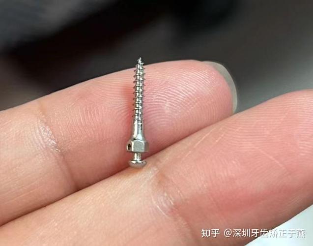 正畸治疗中，患者可以自行携带支抗钉吗？这种做法是否安全有效，又会对矫正效果产生哪些影响？-图2