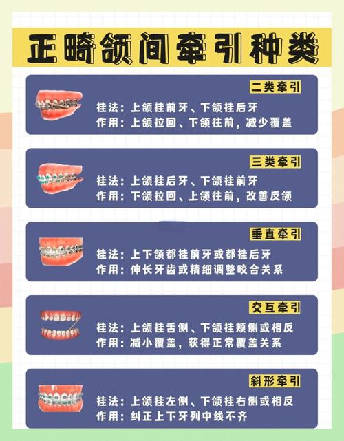 正畸中上颌尖牙向下向后牵引的原理是什么？适用于哪些错颌畸形？临床操作中如何控制牵引方向与效果？-图3