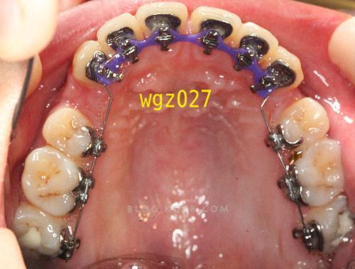 口腔正畸关闭拔牙间隙时，如何选择合适的关闭方法？不同技术（如滑动法、关闭曲法）对牙齿移动效率、稳定性及面部美观的影响有何差异？-图3