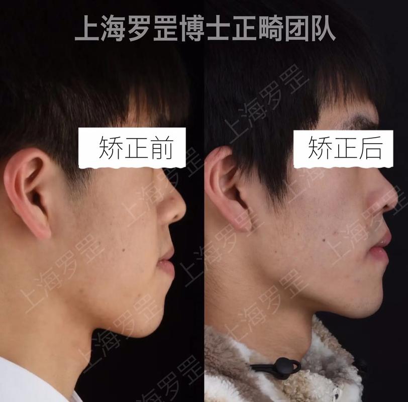 上海华驰牙齿正畸效果怎么样？医生专业度与价格靠谱吗？-图1