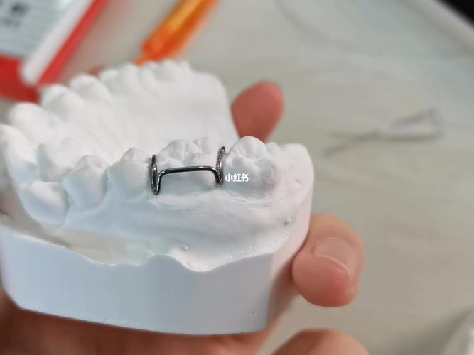 正畸箭头卡环弯制视频是否详细演示了托槽定位与角度控制？弯制过程中需注意哪些关键细节才能确保固位稳定？-图1