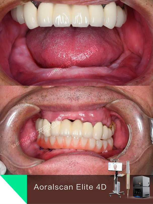 种牙后手术部位出现红肿、疼痛或出血是正常恢复表现吗？术后护理不当会引发哪些并发症？-图3