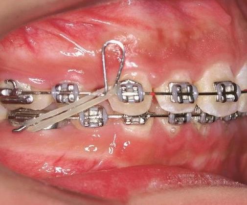 关闭曲弯制方法中如何精准控制弯曲角度以避免形变?有哪些关键工艺参数需要重点把控?-图1 关闭曲弯制方法中如何精准控制弯曲角度以避免形变?有哪些关键工艺参数需要重点把控?-图1