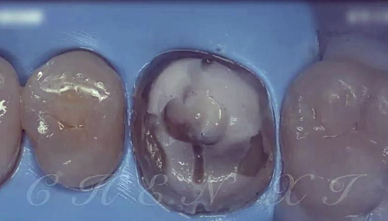 根管内牙胶去除有哪些常用方法?不同残留情况如何选择最佳技术并规避风险?-图2 根管内牙胶去除有哪些常用方法?不同残留情况如何选择最佳技术并规避风险?-图2