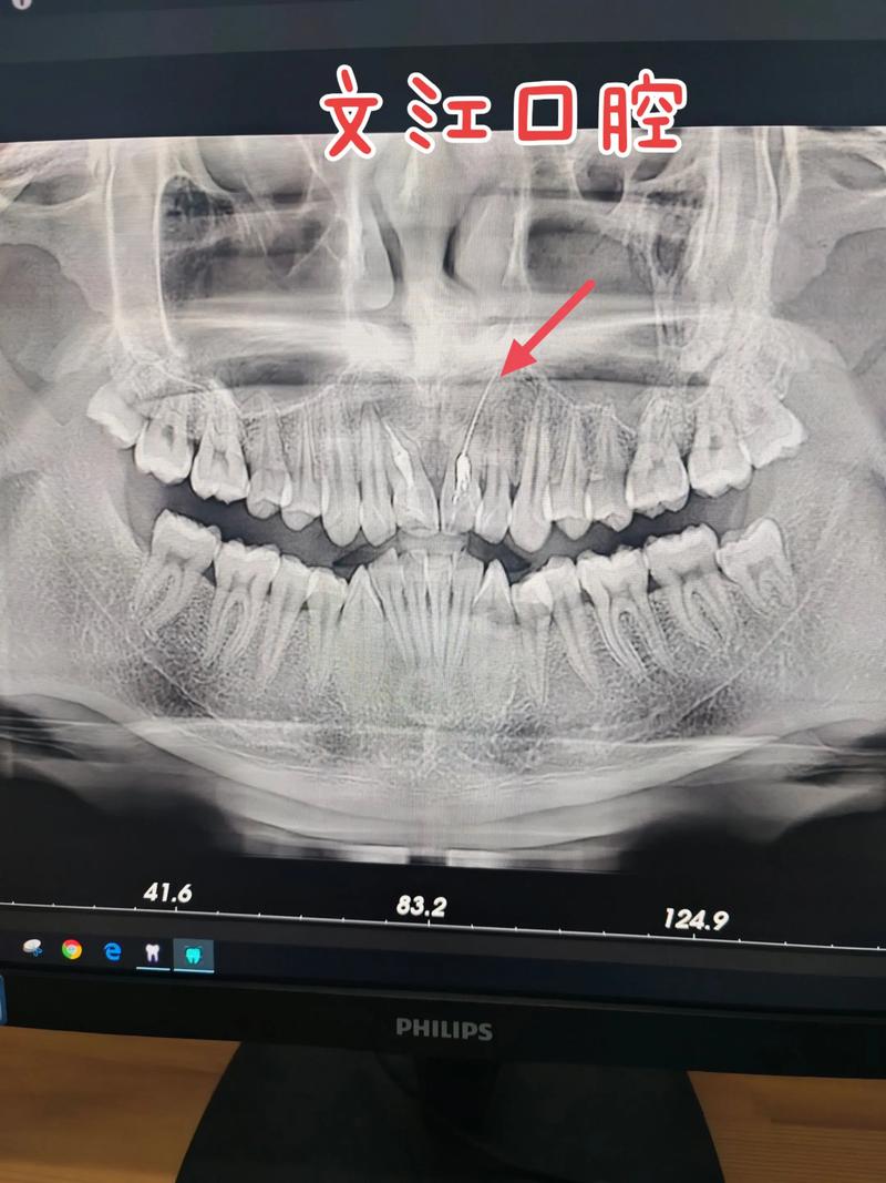 牙CT真的只有一种吗？不同口腔检查需求下，到底有哪些类型的牙CT，它们又有什么技术差异？-图1