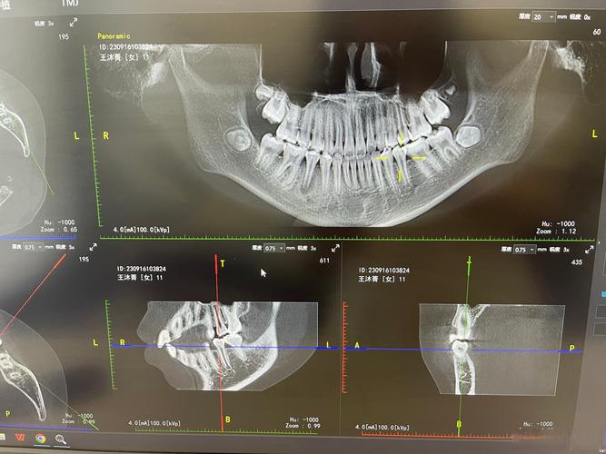 牙CT真的只有一种吗？不同口腔检查需求下，到底有哪些类型的牙CT，它们又有什么技术差异？-图2