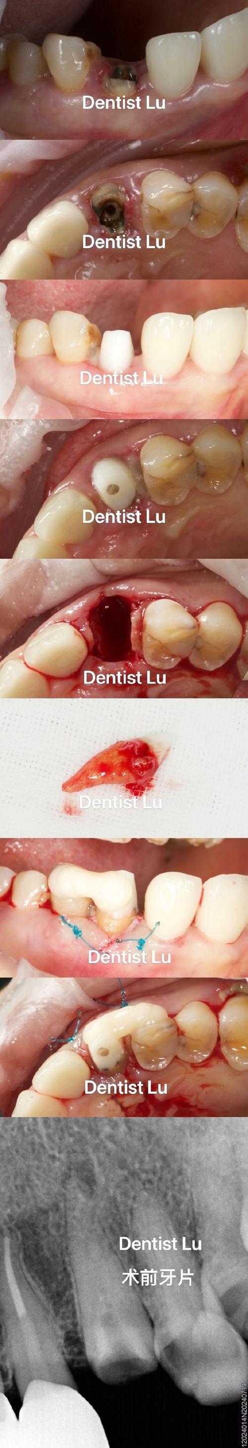 正畸结扎丝划伤牙釉质是操作失误还是材料问题？患者该如何早期发现并科学预防此类损伤？-图3