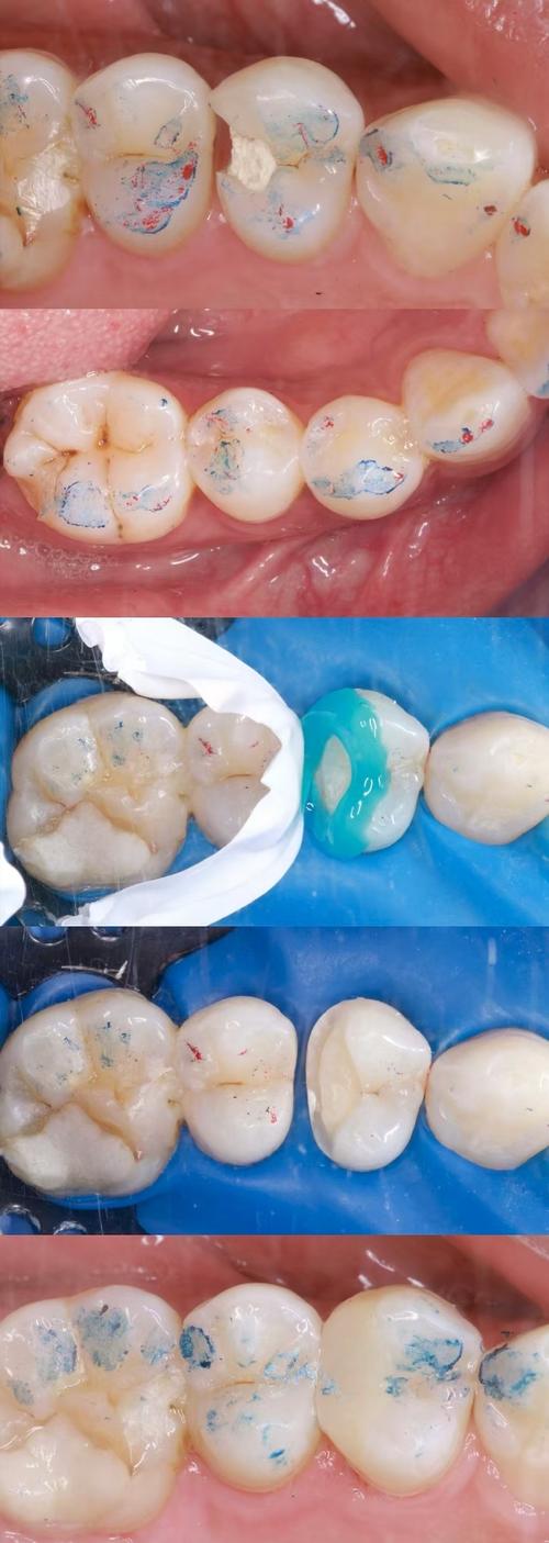 正畸结扎丝划伤牙釉质是操作失误还是材料问题？患者该如何早期发现并科学预防此类损伤？-图1