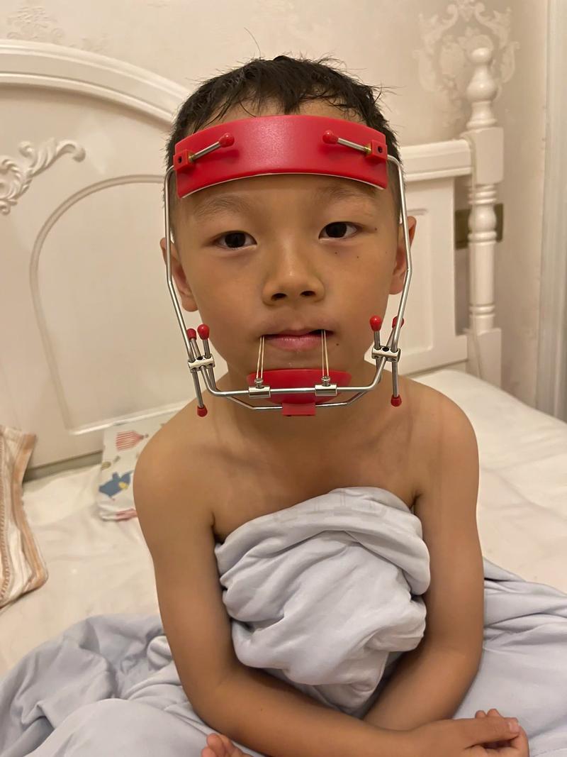 宝宝反颌（地包天）怎么纠正？有哪些安全有效的干预方法？最佳治疗时机是什么时候？-图1