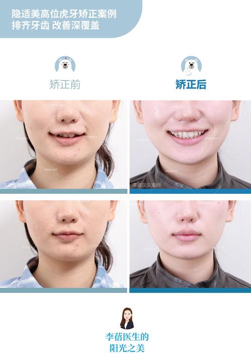 牙齿正畸后出现深覆盖露牙龈是什么原因?如何通过矫正方案调整改善牙龈暴露问题?-图1 牙齿正畸后出现深覆盖露牙龈是什么原因?如何通过矫正方案调整改善牙龈暴露问题?-图1