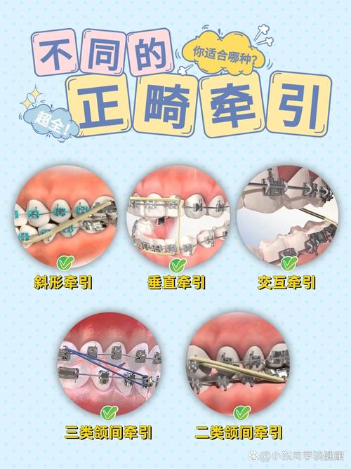 正畸中各种牵引的作用-图1 正畸中各种牵引的作用-图1