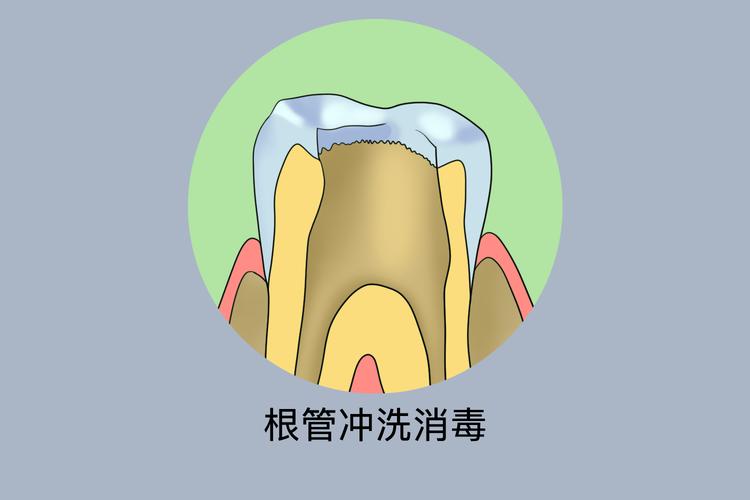 根管消毒的方法有哪些？不同消毒方式的优缺点及适用情况是怎样的？-图1