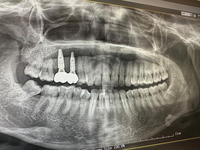种牙前拍X光检查，辐射对身体有影响吗？会影响种牙效果和后期使用吗？-图1