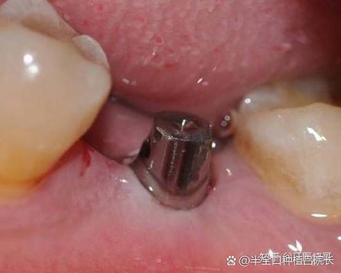 种牙手术真的存在生命危险吗?哪些潜在风险可能危及健康,又该如何有效规避?-图2 种牙手术真的存在生命危险吗?哪些潜在风险可能危及健康,又该如何有效规避?-图2