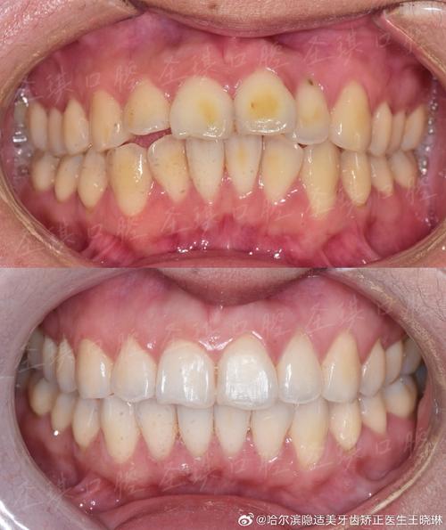 口腔正畸照的拍摄究竟有哪些核心目的？不同阶段的照片如何辅助正畸方案设计与效果评估？-图3