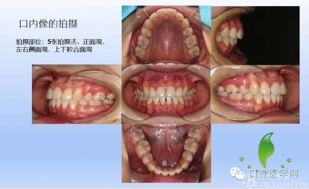 口腔正畸照的拍摄究竟有哪些核心目的？不同阶段的照片如何辅助正畸方案设计与效果评估？-图2