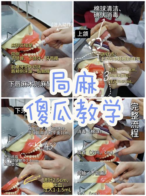 针对不同牙齿（前牙、后牙、乳牙、恒牙），麻醉方法应如何精准选择？注射部位与药物应用有何差异？-图2