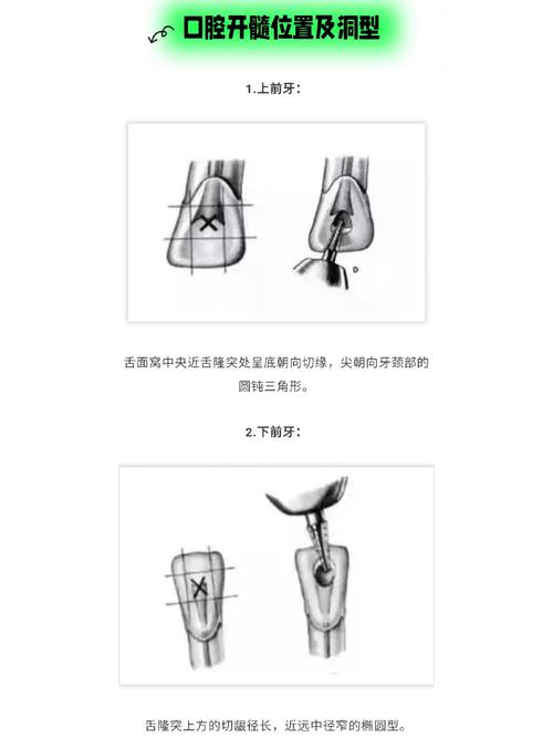 口腔局麻方法开髓-图2
