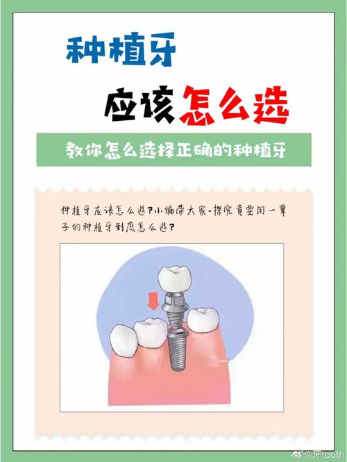 种牙种植体好坏，关键看哪些因素？-图3