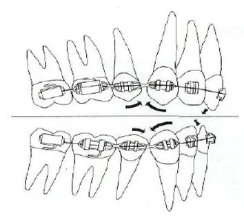 正畸过山车效应，矫正过程为何像坐过山车？-图2
