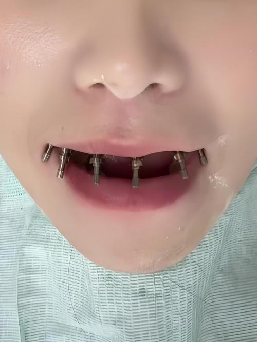 四颗 半口 种牙-图2