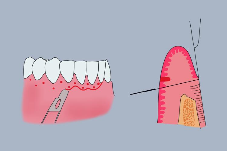 牙周手术缝合方法的选择与操作要点是什么？-图1