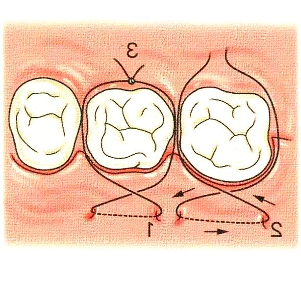 牙周手术缝合方法的选择与操作要点是什么？-图2