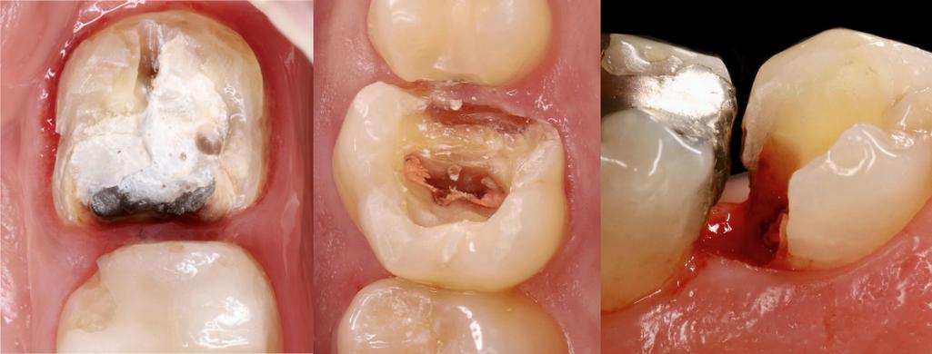 如何进行RCT修复?有哪些常用方法?-图1 如何进行RCT修复?有哪些常用方法?-图1