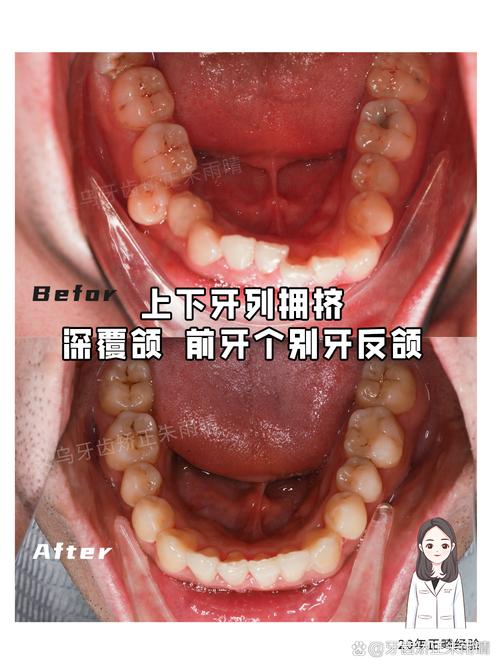 牙齿拥挤正畸的过程是怎样的？关键步骤有哪些？-图2